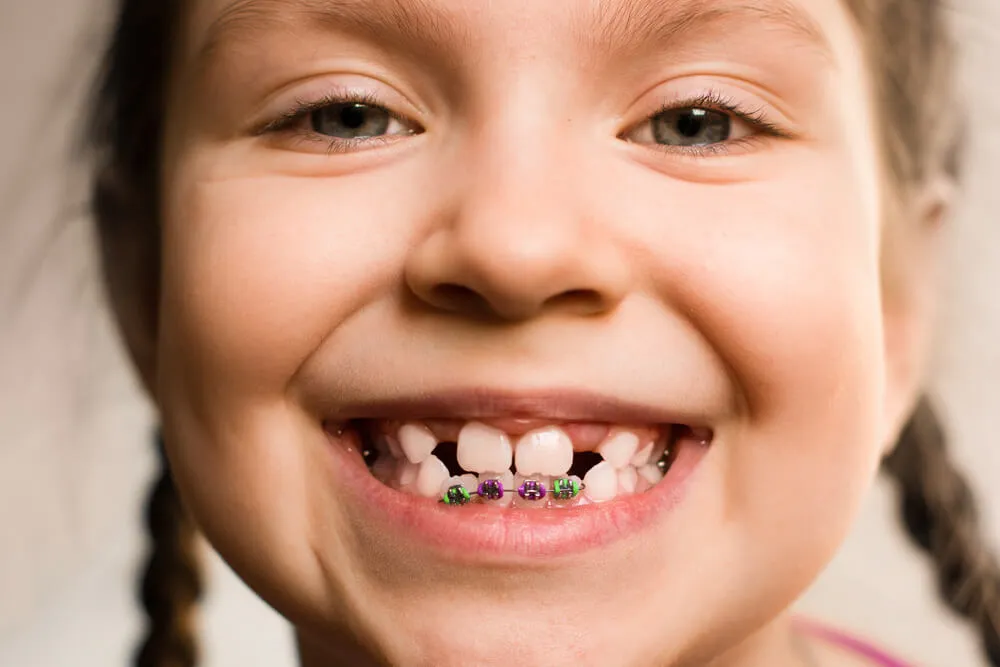 Orthodontics for Children: A Look into Why It Is Important - KidShine